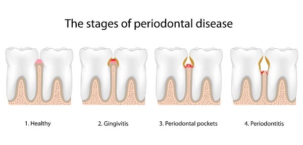 Periodontitis stages