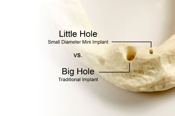 Mini dental implant cost Singapore