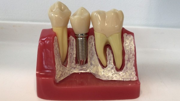 Dental implant Singapore