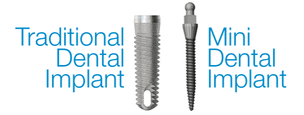 mini dental implants Singapore