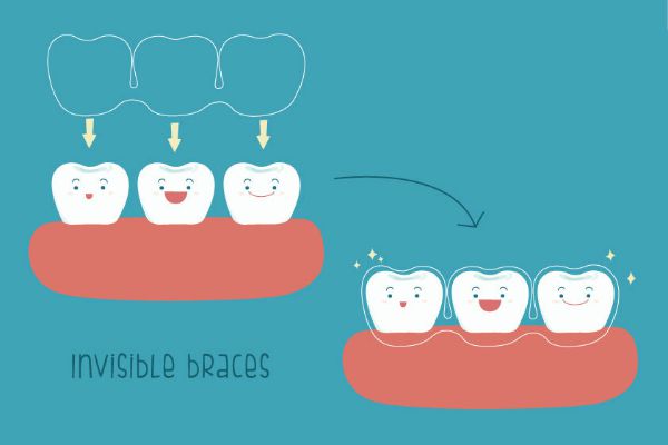 illustration of clear aligner treatment