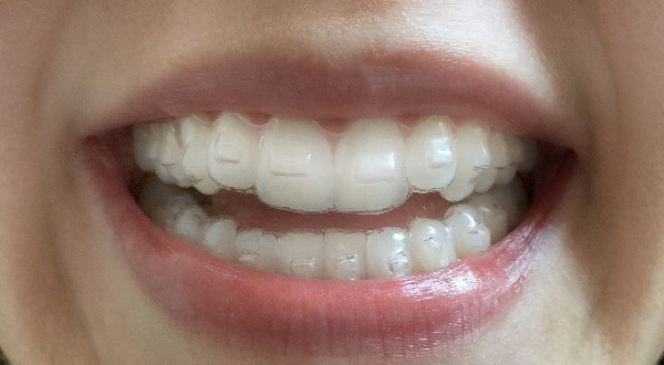 person wearing invisalign