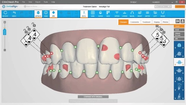 clincheck screen for invisalign treatment