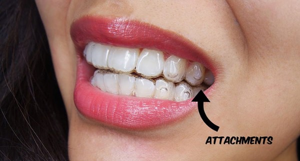 woman with invisalign on her teeth