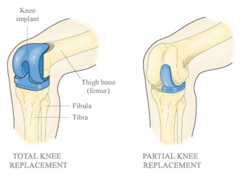 Knee replacement cost Singapore