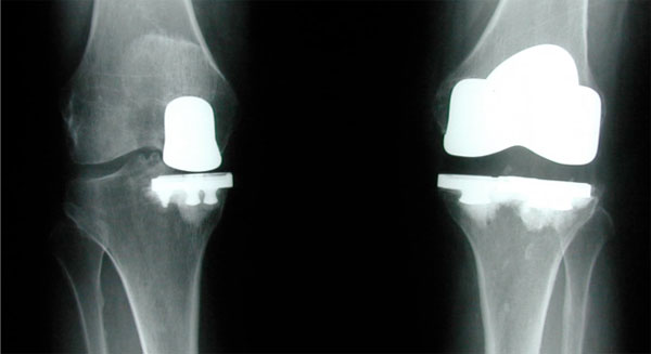 partial knee replacement Singapore