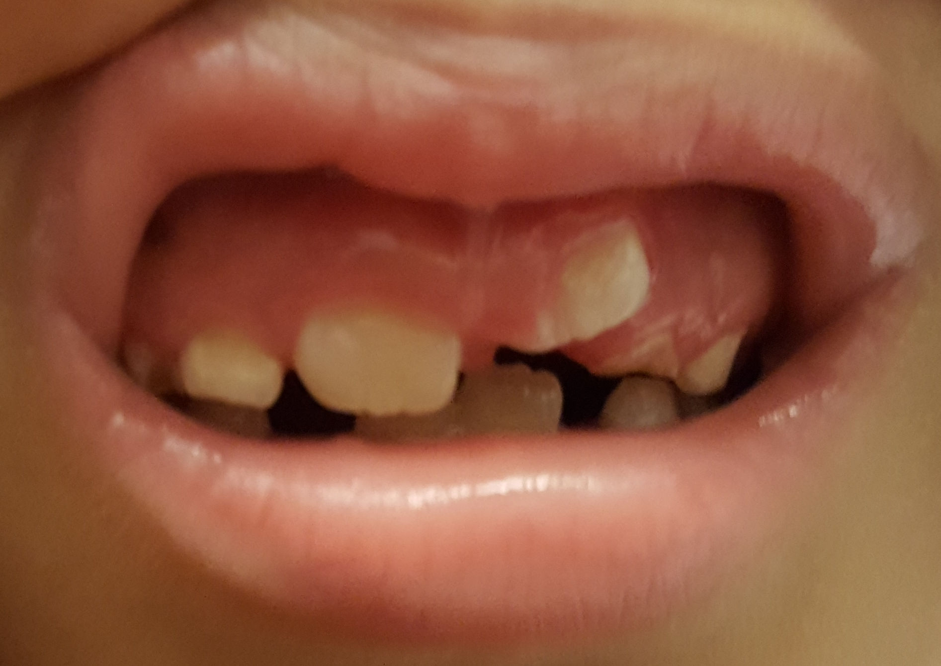 tooth growing permanent child position should teeth gum incorrect children xray tan doctor grown crooked side extracted thing orthodontist done