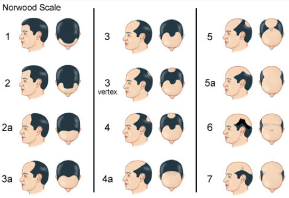 Hair loss treatment Singapore