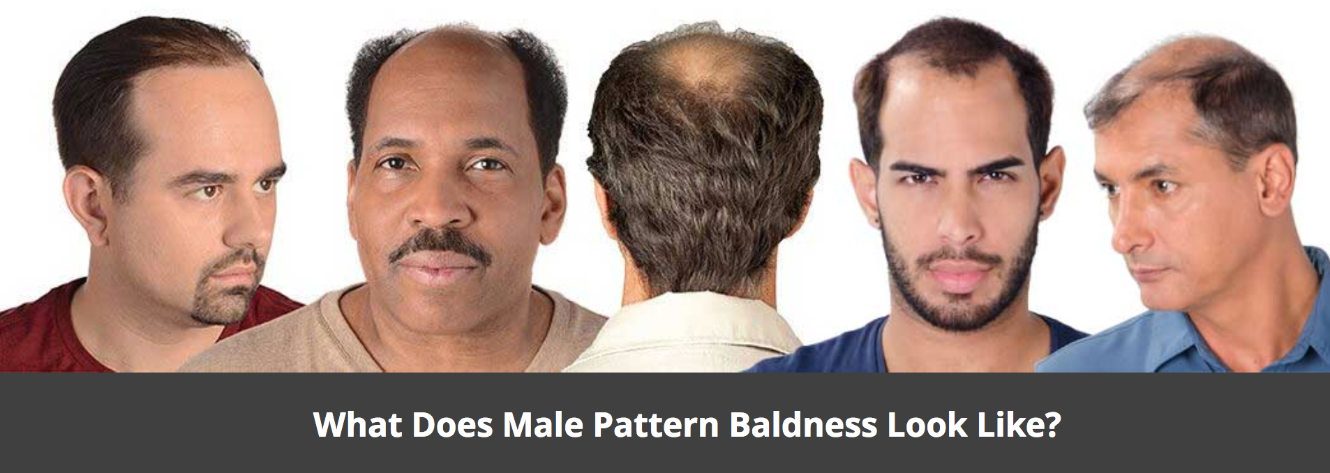 hair loss singapore