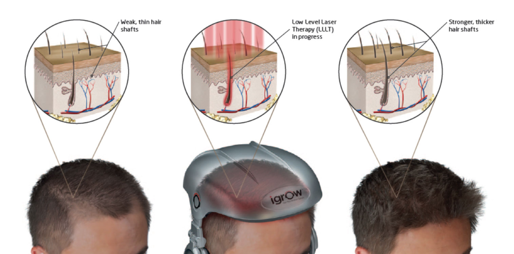 Low-Level Laser Therapy Singapore