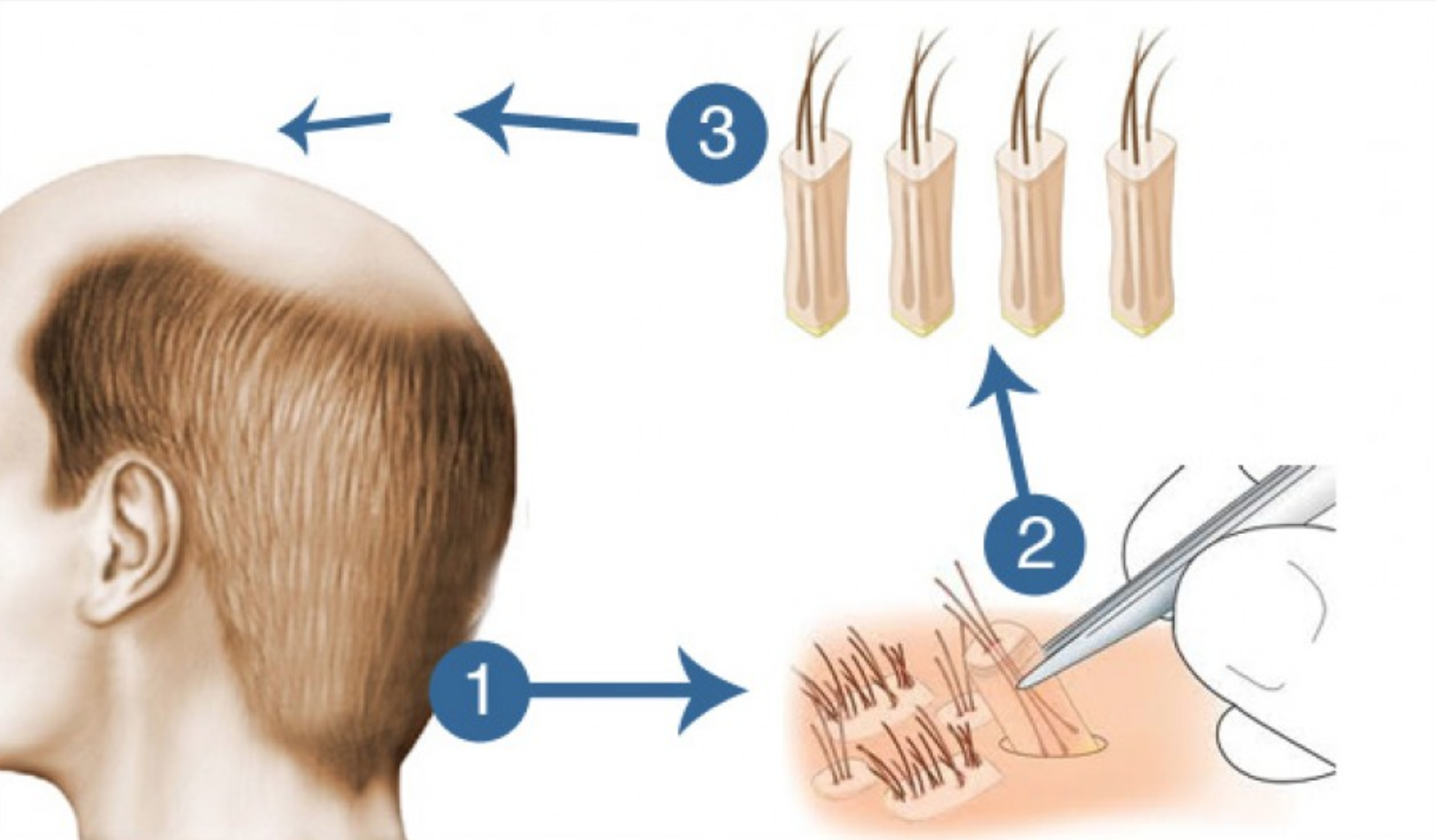 hair transplant Singapore