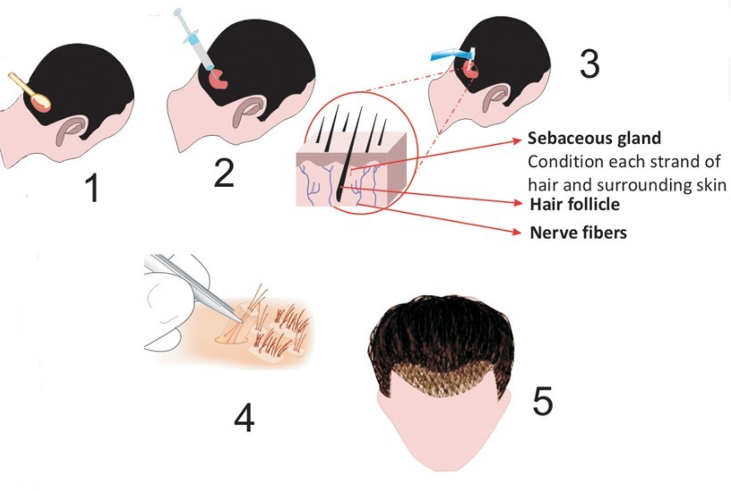 hair transplant Singapore