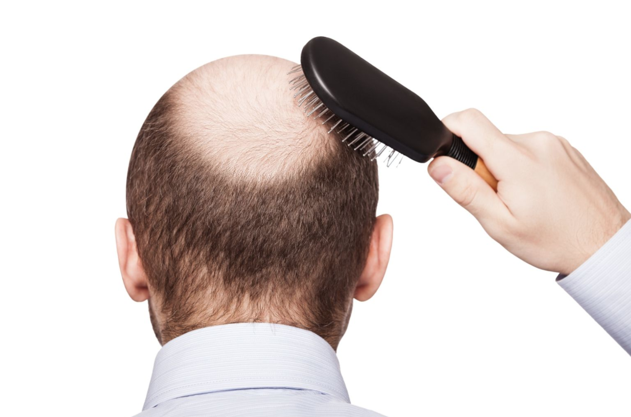 hair loss singapore