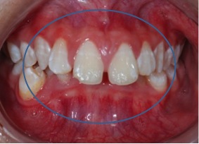 Fig. 6 Deep bite: where the lower incisors are biting on the upper gums.