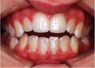 Fig. 7 An open bite where the upper and lower front teeth do not meet.