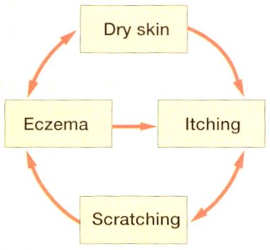 Vicious circle eczema