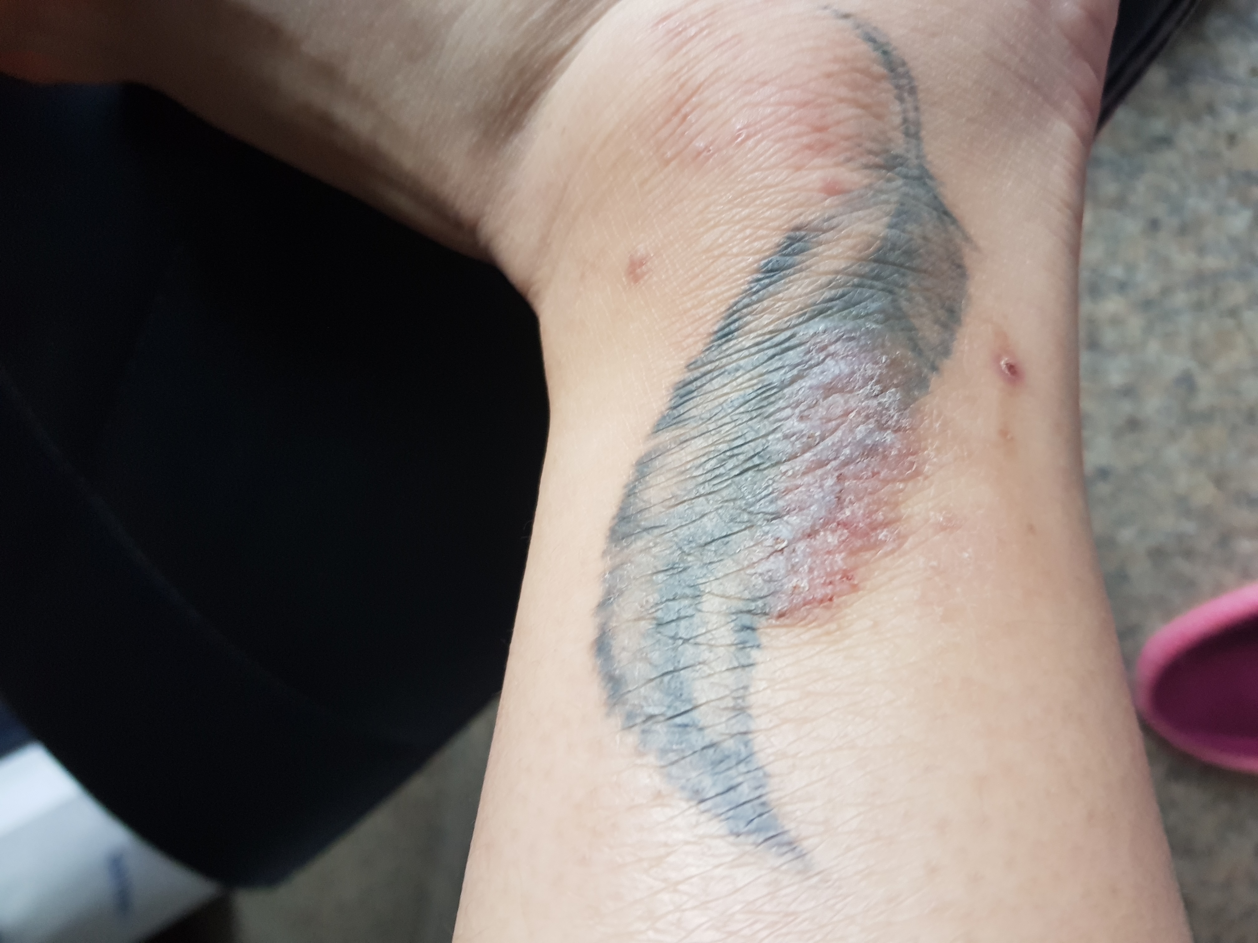 5 Causes Of A Tattoo Rash And How To Treat It  SkinKraft