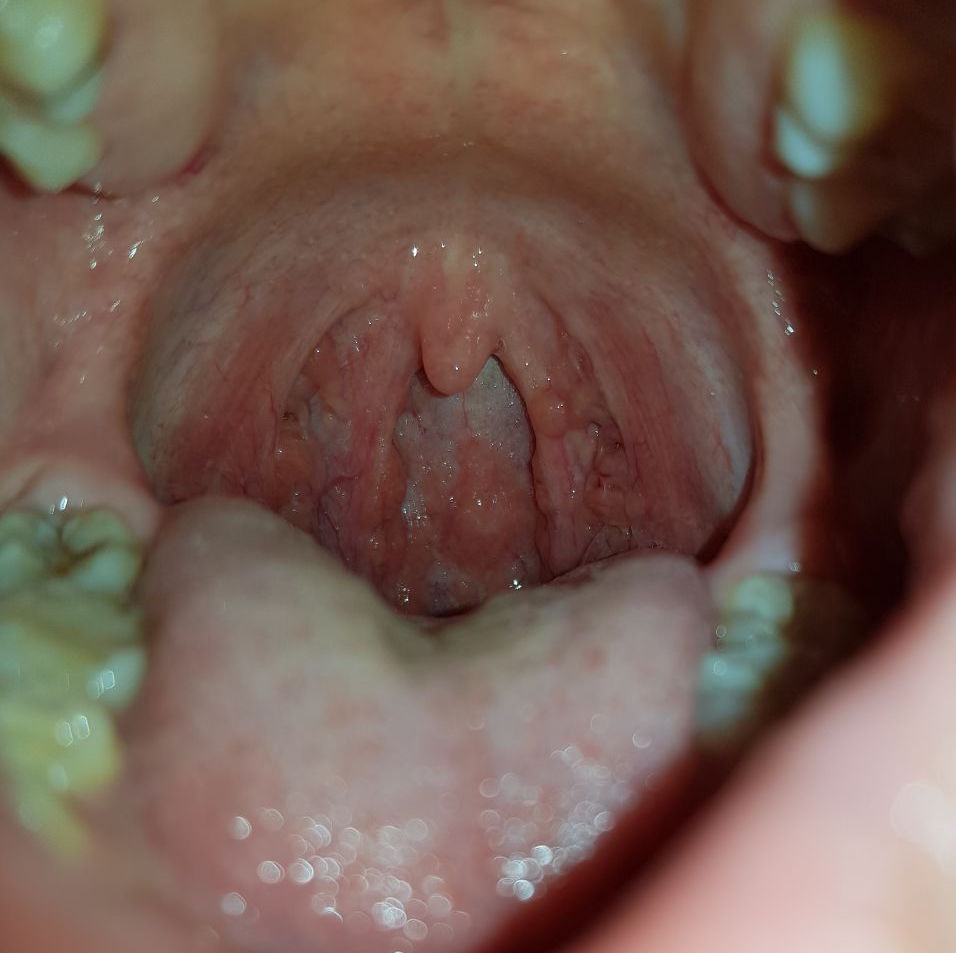 bumps on back of throat