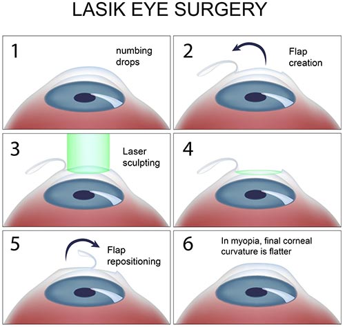 lasik illustrated diagram