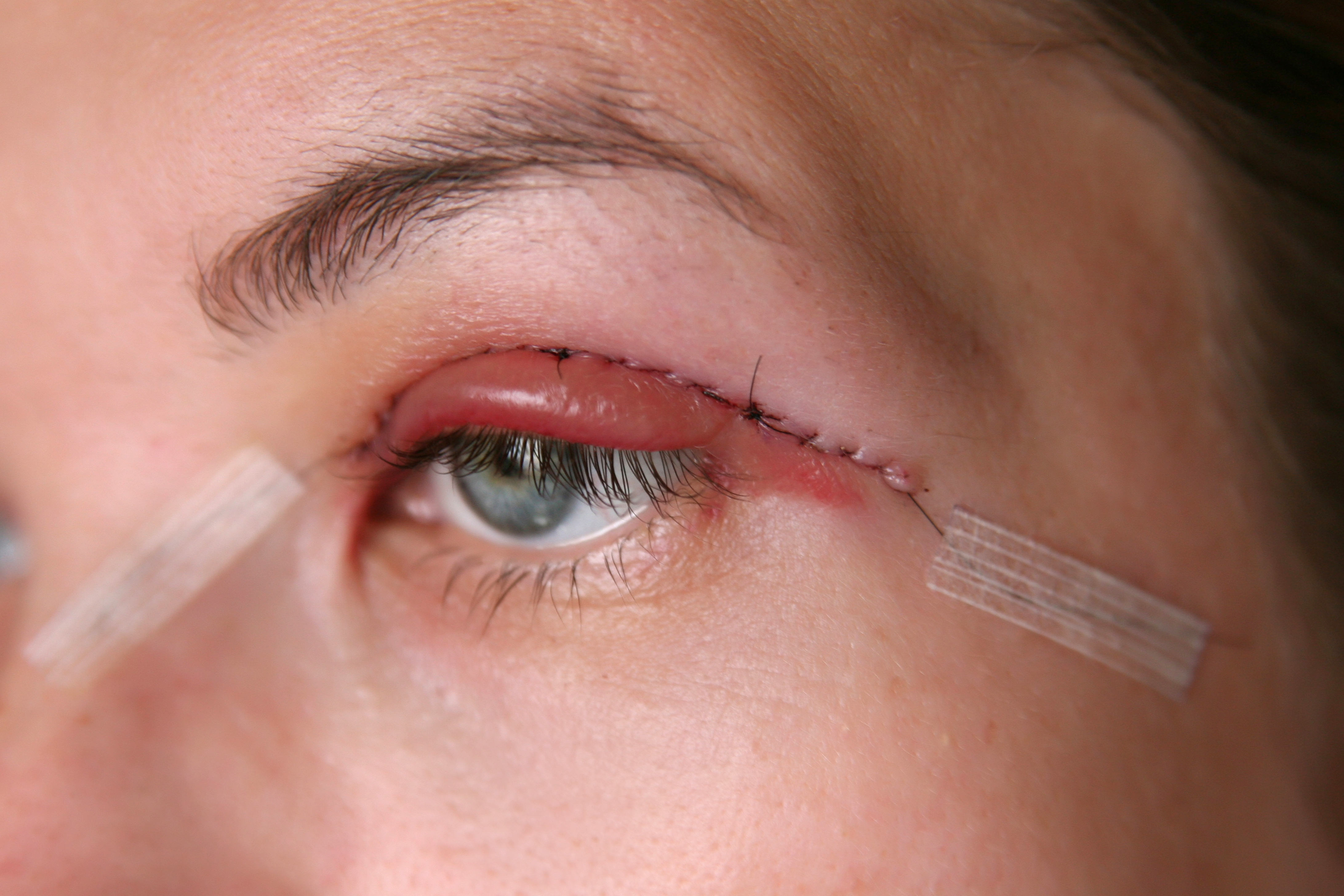 eyelid glue permanent crease