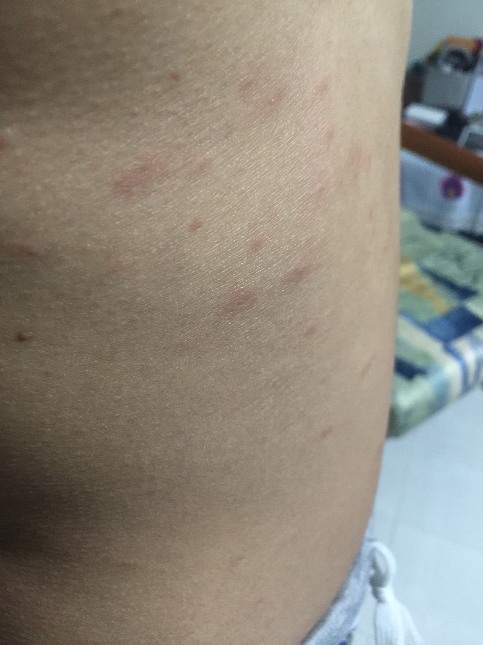 What Could Be The Cause Of Non Itchy Red Rashes On My Torso Photos