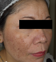 melasma treatment