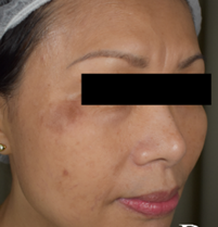 Post Inflammatory Hyperpigmentation (PIH)