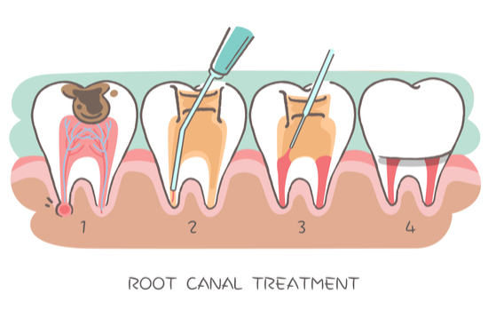 Root canal treatment cost singapore