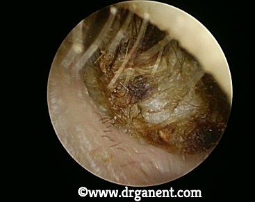 earwax removal singapore