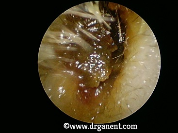 earwax removal singapore