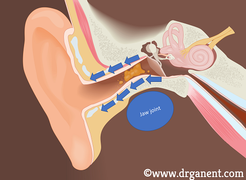 earwax removal singapore