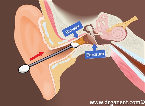 earwax singapore