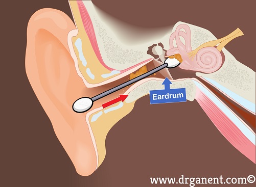 earwax singapore