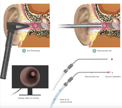 earwax removal singapore