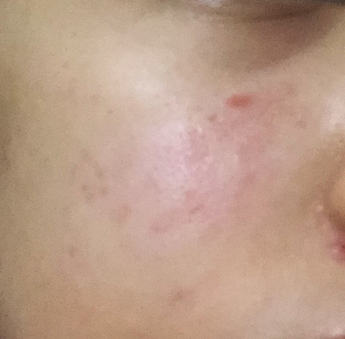 How do I get rid of redness at my cheeks that appears after I shower