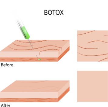 Botox infographic