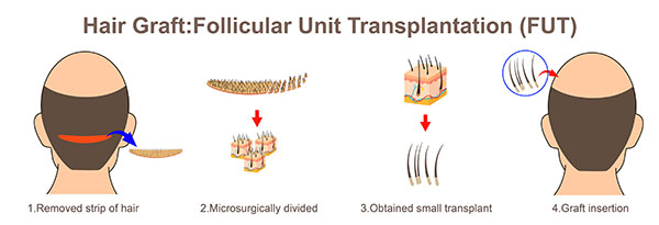 hair transplantation (FUT)