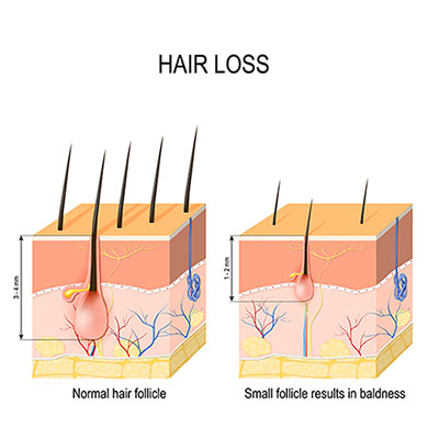 hair loss singapore