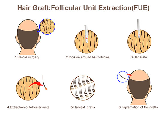 Hair graft: Follicular unit extraction (FUE)