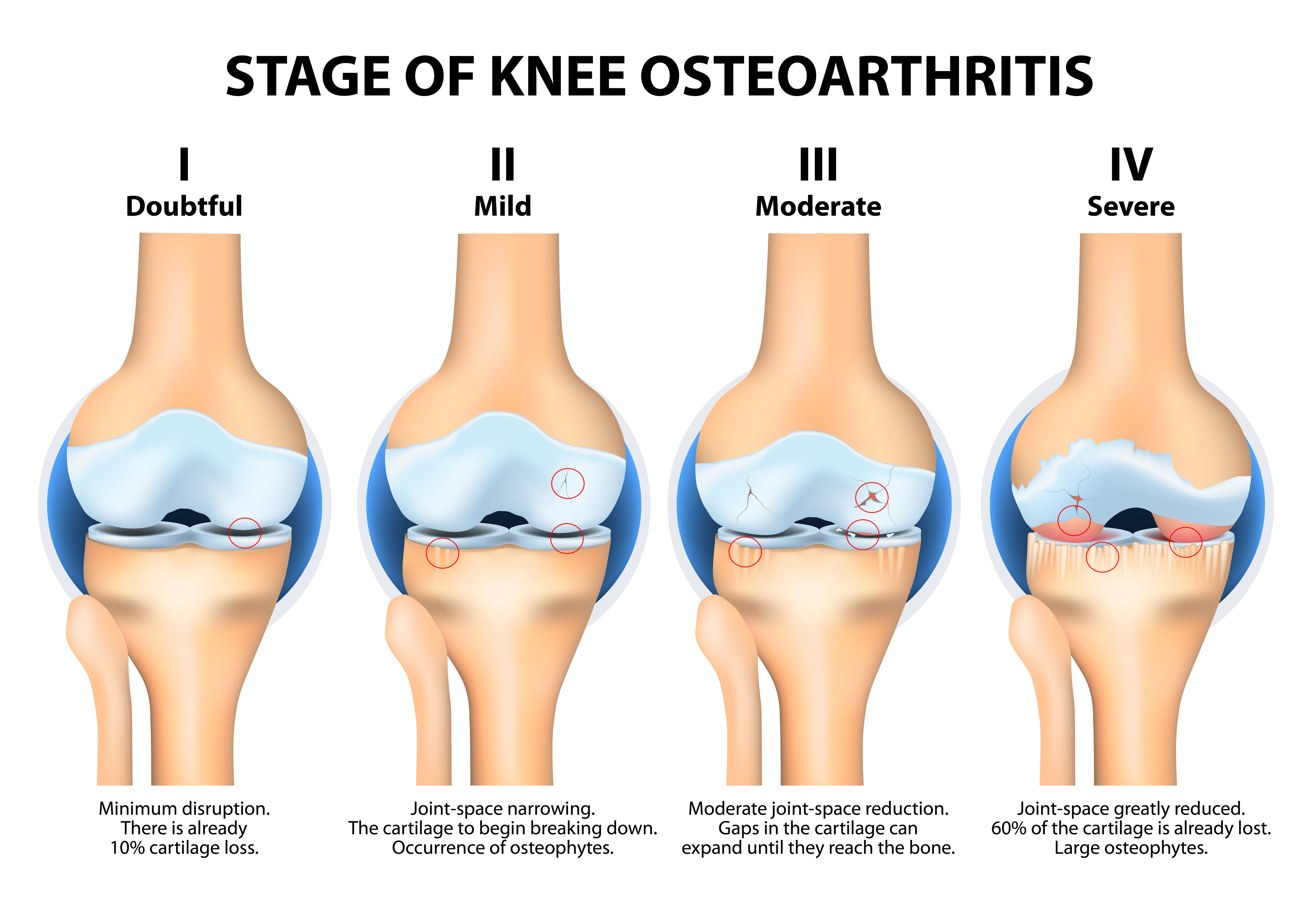 severe arthritis in Singapore