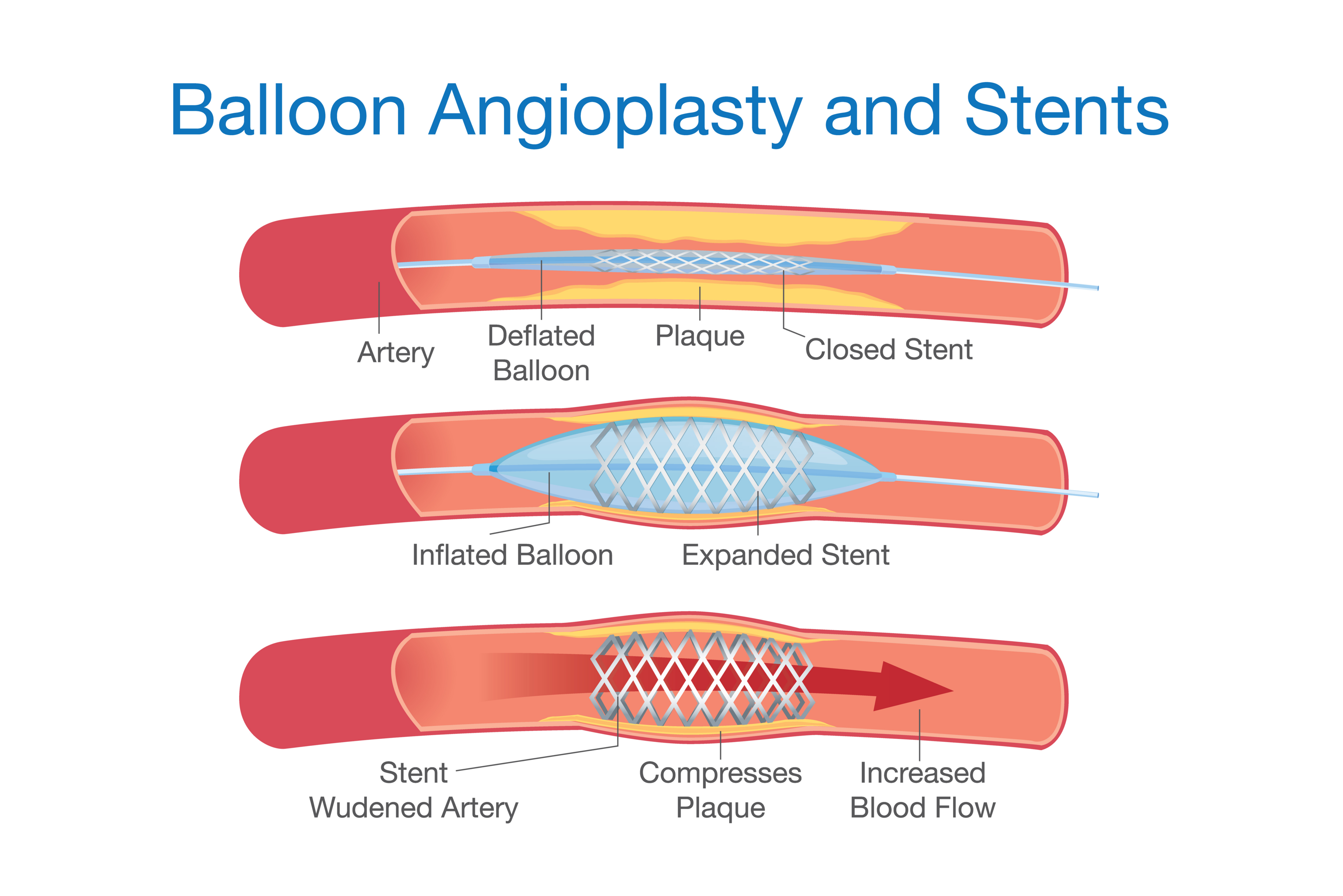 angioplasty procedure and cost in Singapore