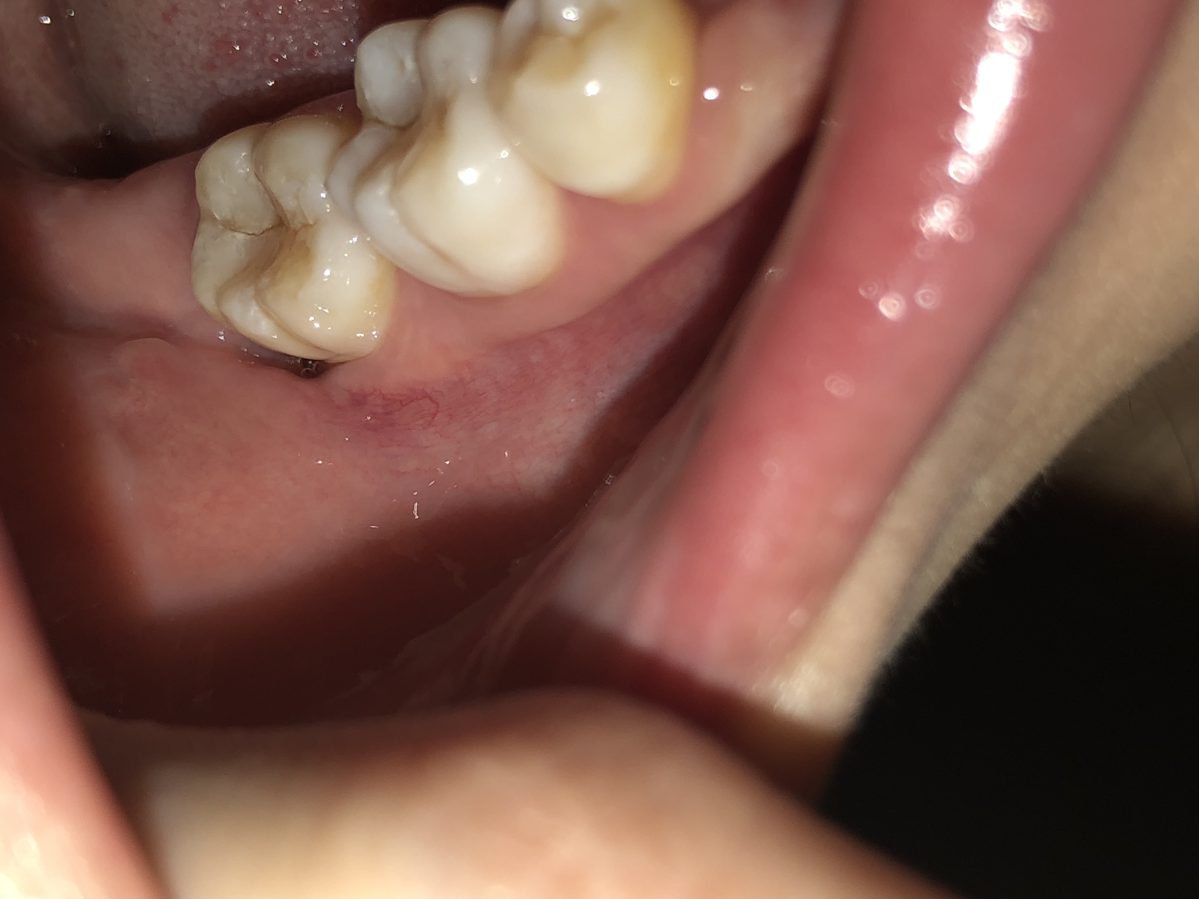 wisdom teeth food stuck