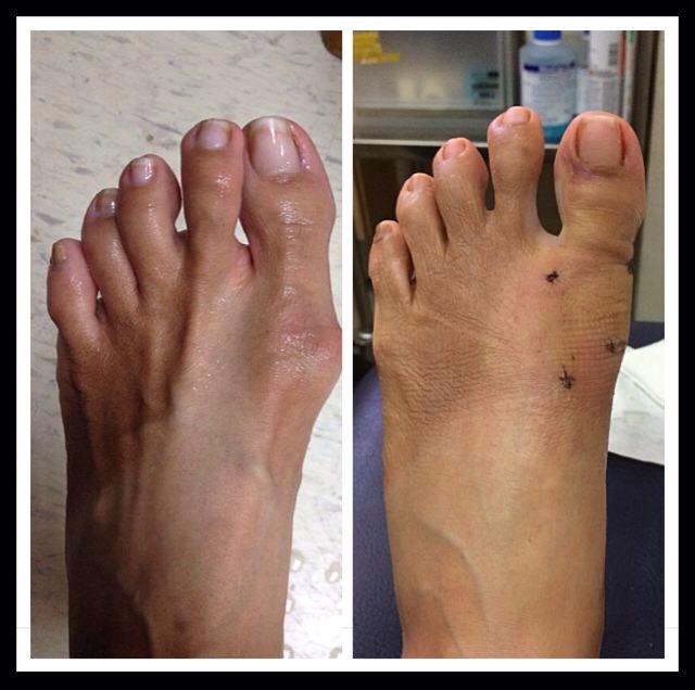 Recovery from Bunion surgery in Singapore