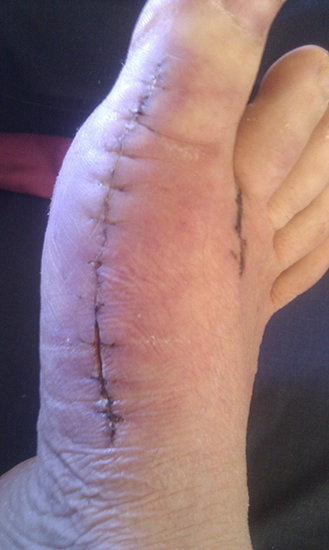 Open scar from bunion surgery singapore