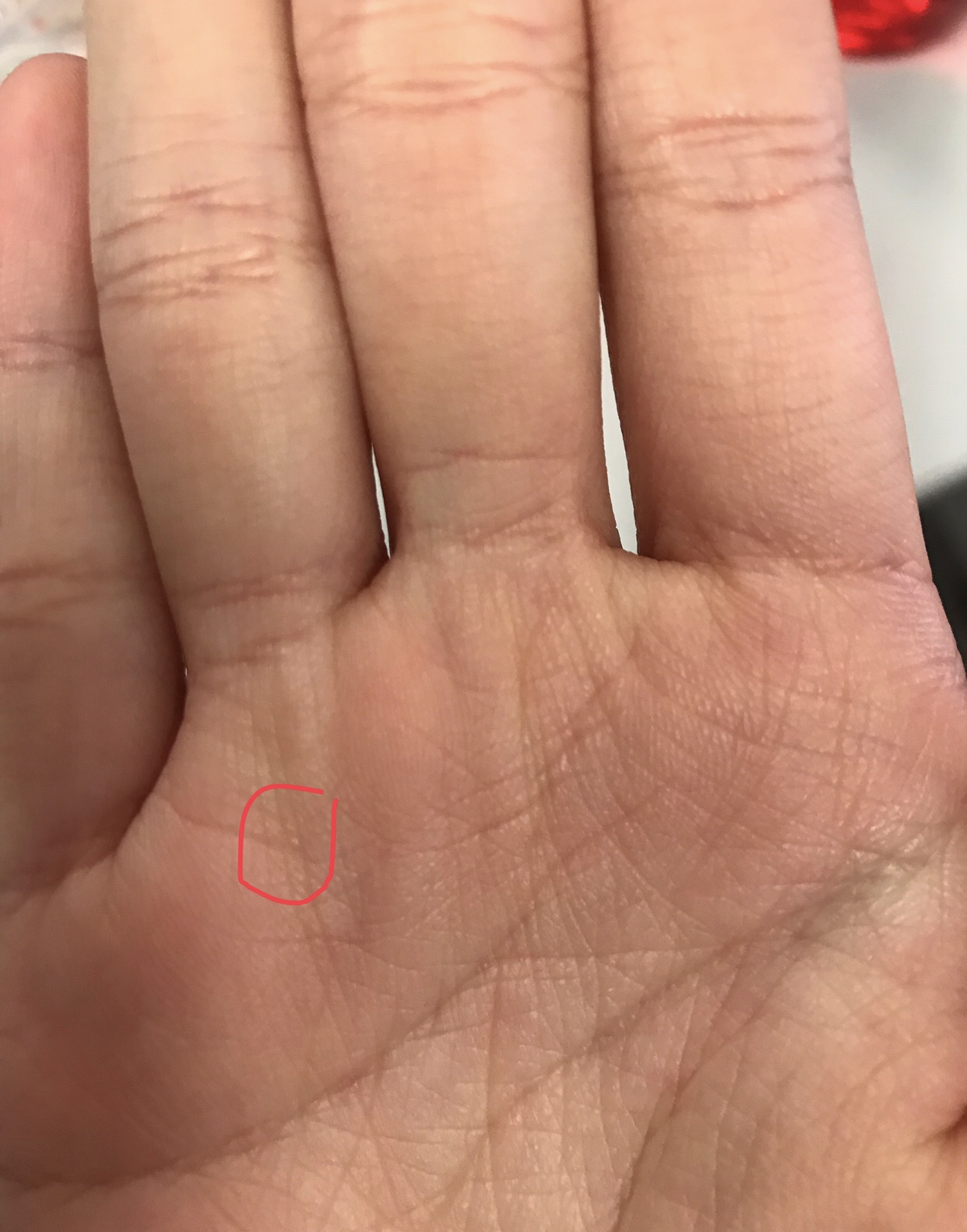 Why Is There A Small Bump On My Ring Finger