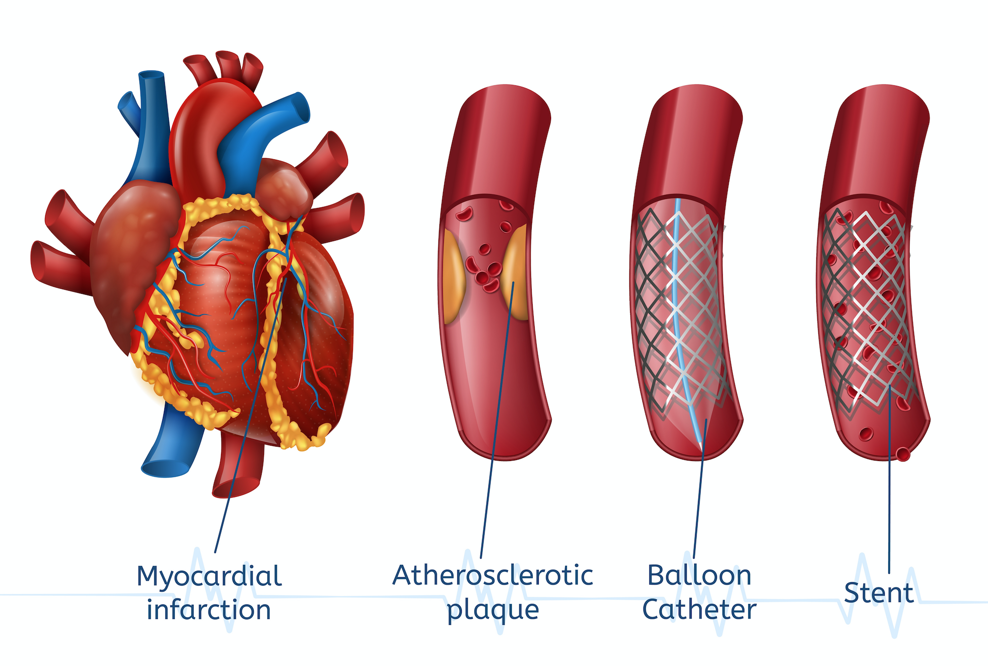 angioplasty Singapore