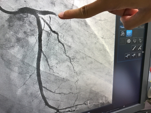 angiogram in Singapore