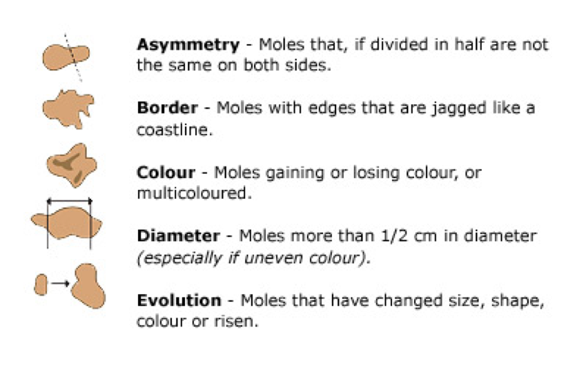 moles and skin cancer