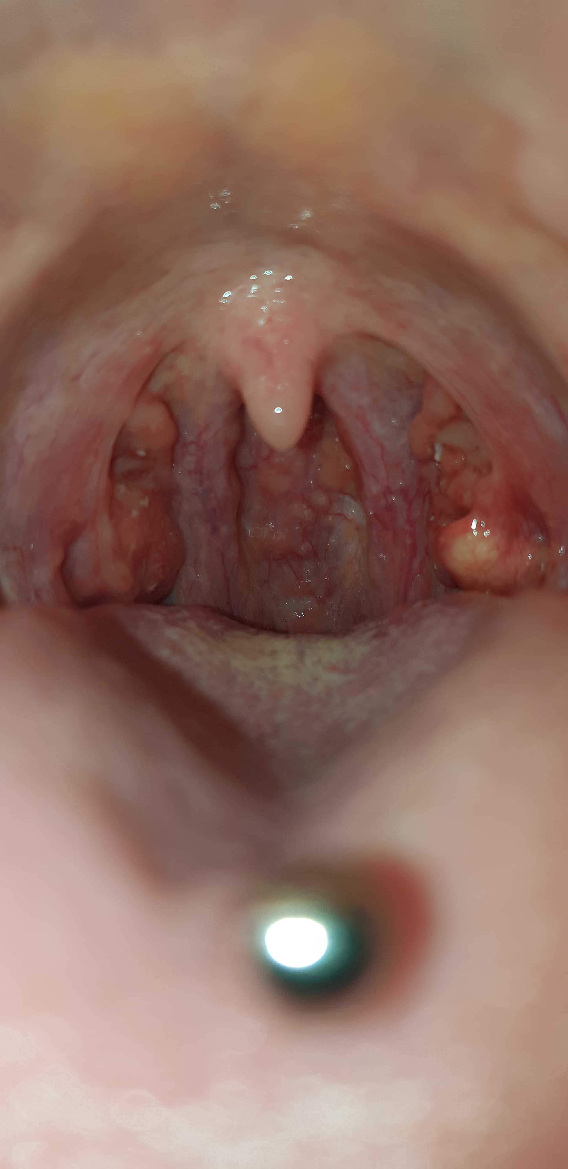 What could cause a white lump on the tonsil in someone with recurrent throat  infections? (photo) - human