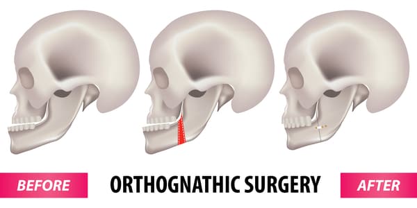 jaw surgery singapore